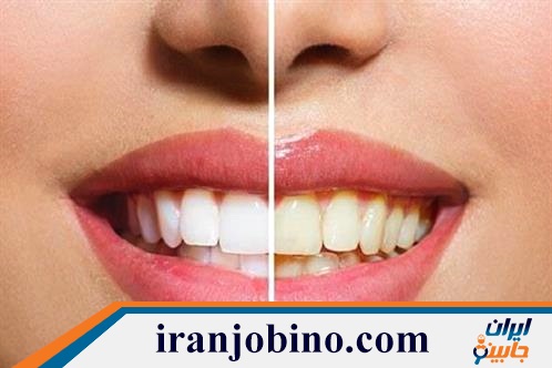 متخصص بلیچینگ دندان در رستم آباد تهران