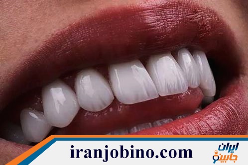 متخصص لمینت دندان در چیذر تهران