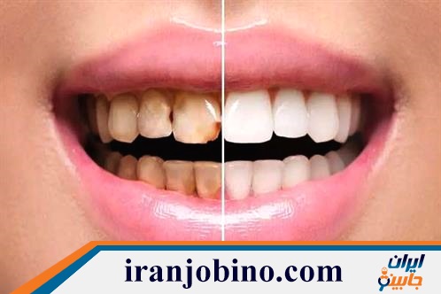 متخصص کامپوزیت دندان در شهرک نفت تهران