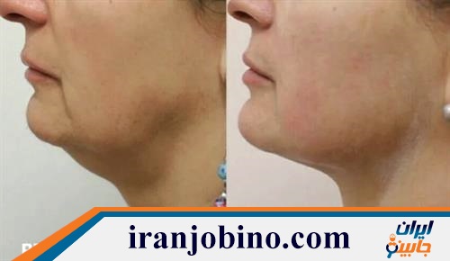 کلینیک هایفوتراپی در تهرانپارس شرقی 