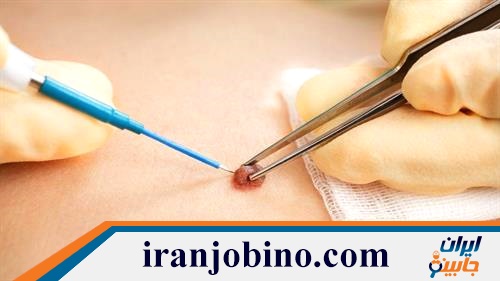 کلینیک برداشتن خال و زگیل در شمال تهران 