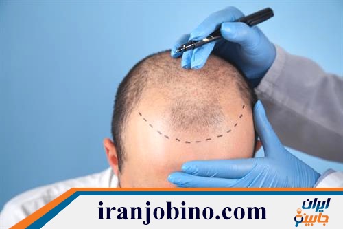 دکتر و کلینیک پی آر پی مو در تهرانپارس شرقی 