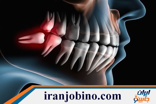 متخصص جراحی دندان عقل در عباس آباد تهران