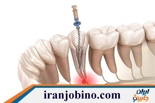 متخصص عصب کشی دندان در خیابان دولت تهران