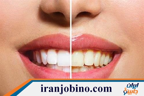 متخصص بلیچینگ دندان در خانی آباد نو تهران