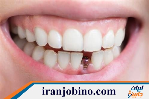 متخصص ایمپلنت دندان در شهرک استقلال تهران