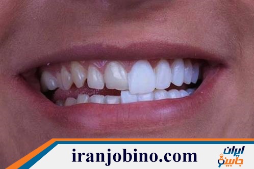 متخصص لمینت دندان