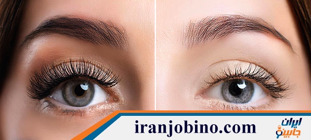 کاشت مژه  در ایران زمین شمالی تهران