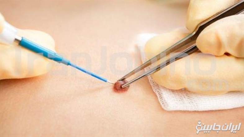 ویژگی های بهترین کلینیک برای برداشتن خال و زگیل
