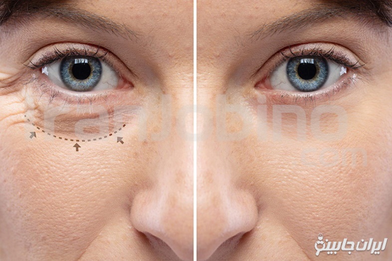 مزایای انجام بلفاروپلاستی