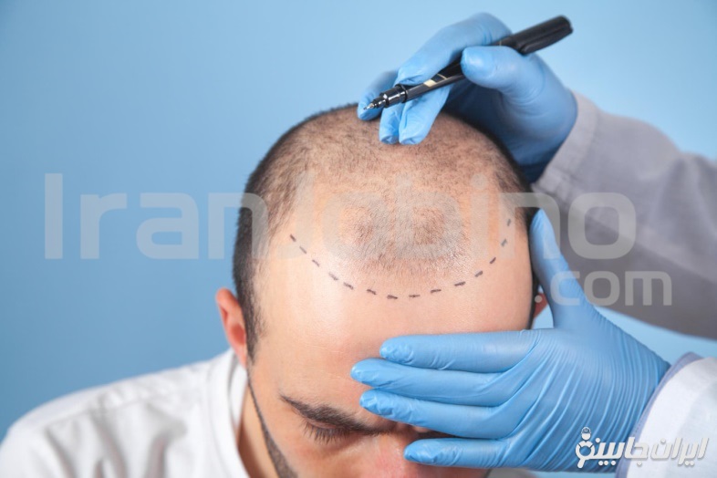 ویژگی های بهترین کلینیک پی آر پی مو