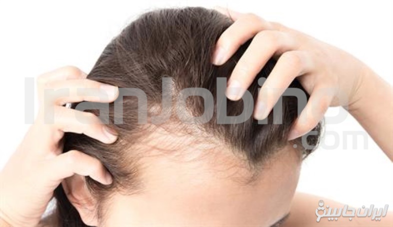 مزایای پی آر پی مو