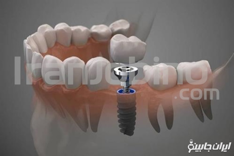 ایمپلنت دندان
