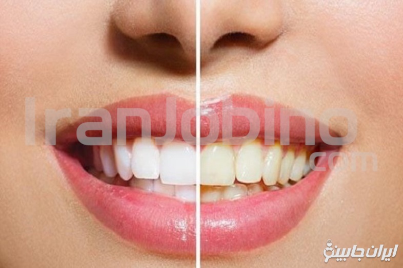 مزایای مراجعه به متخصص بلیچینگ دندان