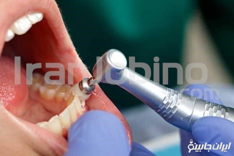 جرم گیری دندان