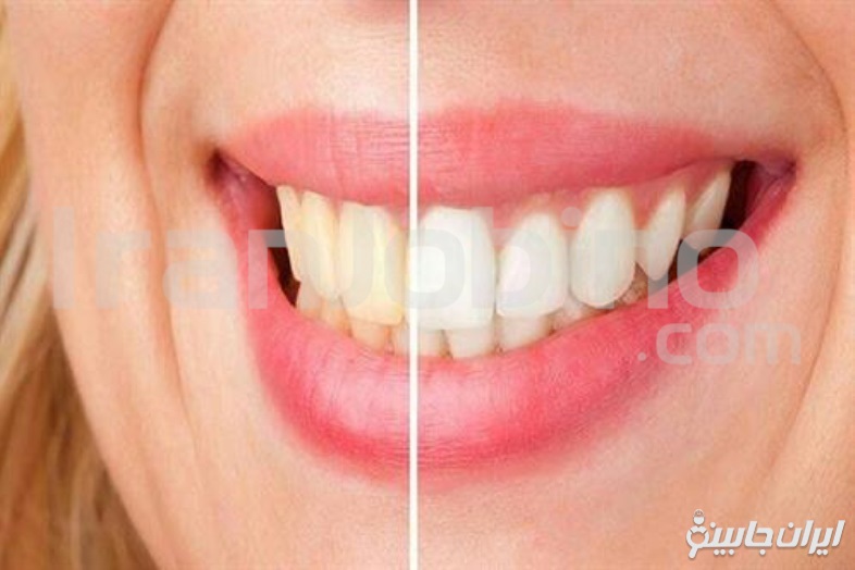 ویژگی های بهترین مرکز جرم گیری دندان