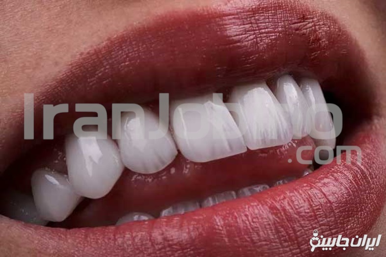 لمینت دندان