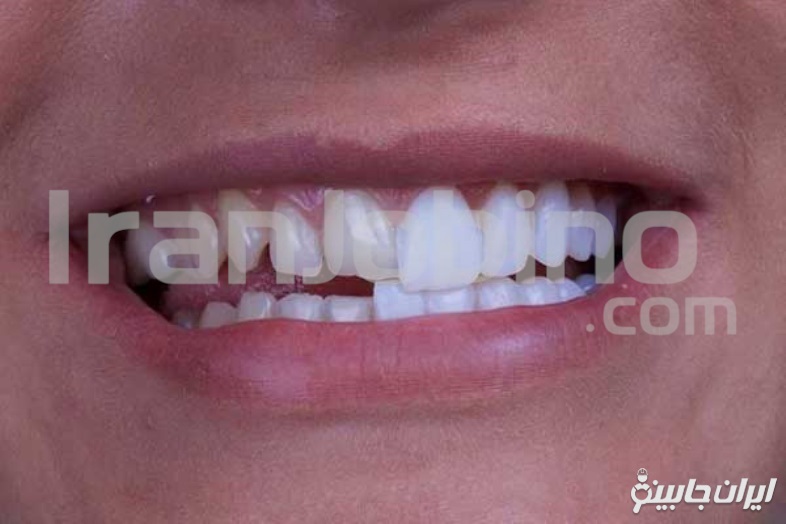 مزایای مراجعه به متخصص لمینت دندان