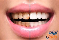 متخصص کامپوزیت دندان در شهرک نفت تهران