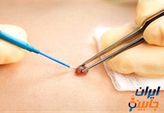 کلینیک برداشتن خال و زگیل در شمال تهران 