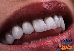 متخصص لمینت دندان در ولیعصر بین پارک وی و نیایش تهران