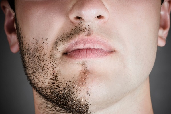 کاربرد و فواید لیزر موهای زائد صورت مردان