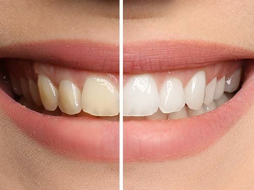 بلیچینگ دندان