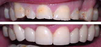 کامپوزیت دندان