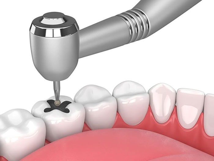 انواع خدمات دندانپزشکی زیبایی و ترمیمی