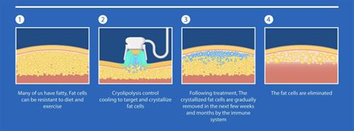 استفاده از کرایولیپولیز برای لاغری موضعی