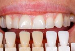 کامپوزیت ونیر و لمینت دندان چه فرقی با هم دارند؟