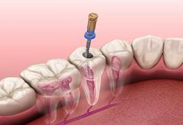 خدمات عصب کشی دندان