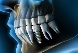 ایمپلنت دندان با روکش تمام سرامیک 