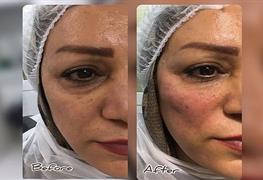 رفع تیرگی زیر چشم