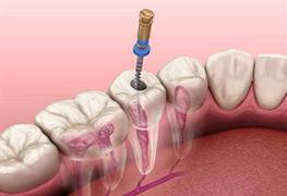 درمان ریشه دندان ( روت کانال تراپی )