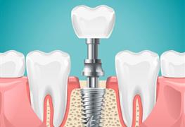 ایمپلنت دندان