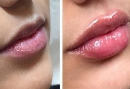  تزریق بوتاکس و ژل