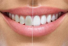 نمایش توضیحات بلیچینگ دندان