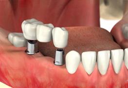 نمایش توضیحات جراحی و ایمپلنت