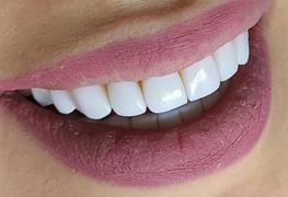 لمینت های (veneers)کامپوزیتی