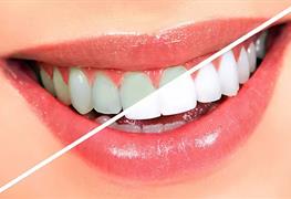 بلیچینگ دندان (سفید کردن دندان)