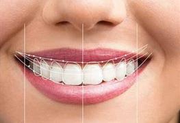 اصلاح و بازسازی خط لبخند