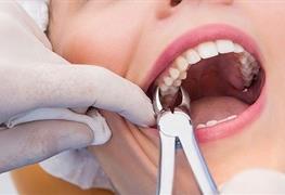 نمایش توضیحات جراحی دندان عقل