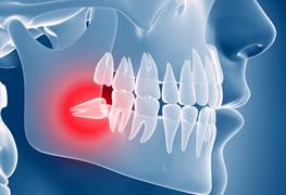 نمایش توضیحات جراحی دندان های نهفته