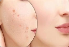 برداشتن خال، رفع جای بخیه و جوش