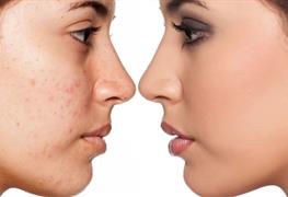 رفع جای جوش های عمیق