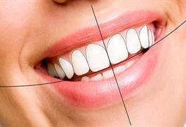طراحی لبخند هالیودی
