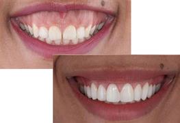 نمایش توضیحات لیفت لثه