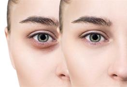 تزریق فیلر زیر چشم