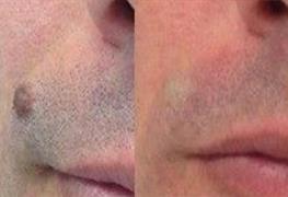 پاکسازی خال و زوائد گوشتی